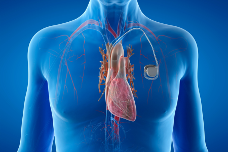 Colocación De Marcapasos